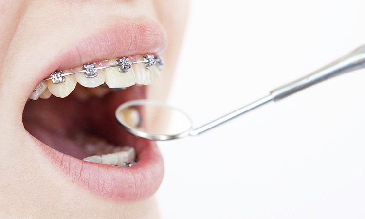 歯科矯正中は虫歯になりやすい理由